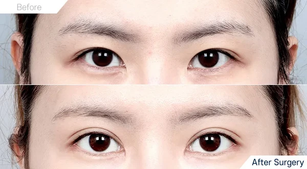Upper blepharoplasty
